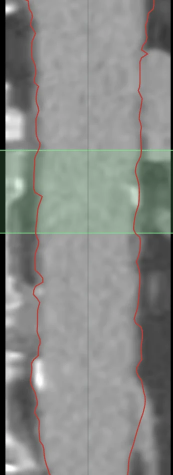 Reconstrucción curva (CPR) de la aorta con el contorno del lumen
