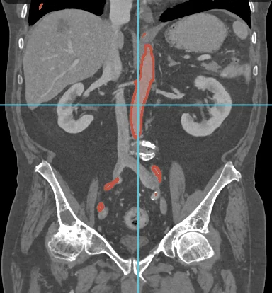 Corte coronal de TC con la aorta marcada
