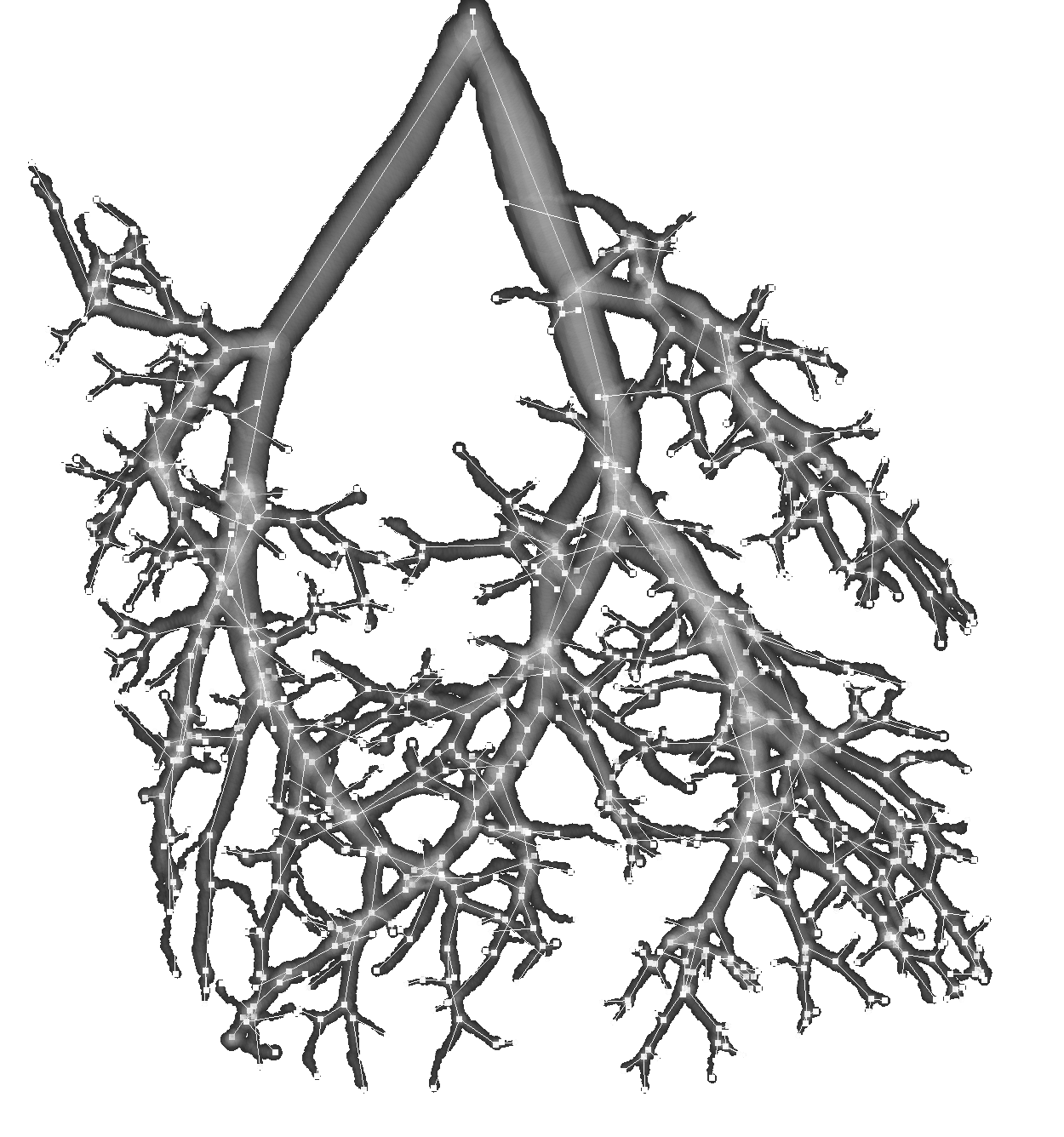 Árbol vascular pulmonar con anomalías detectadas y marcadas